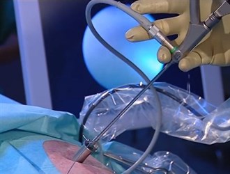 Лазерная уретеролитотрипсия